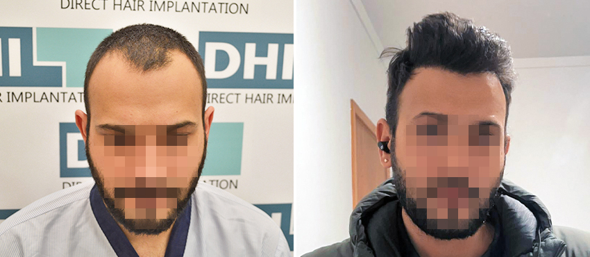 DHI before & after hair transplant results